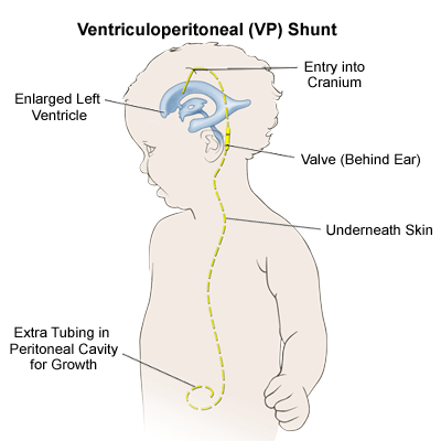ventriculoperitoneal shunt complications